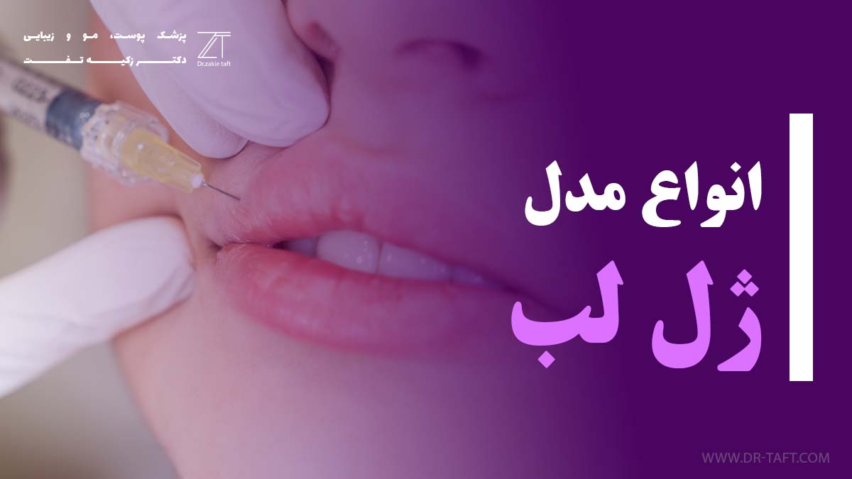 انواع مدل تزریق ژل لب