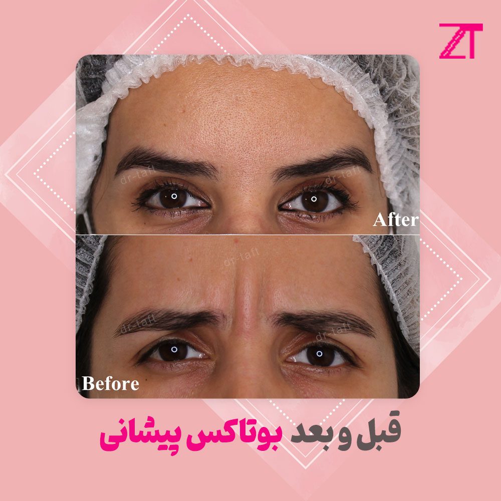 عکس قبل و بعد بوتاکس پیشانی