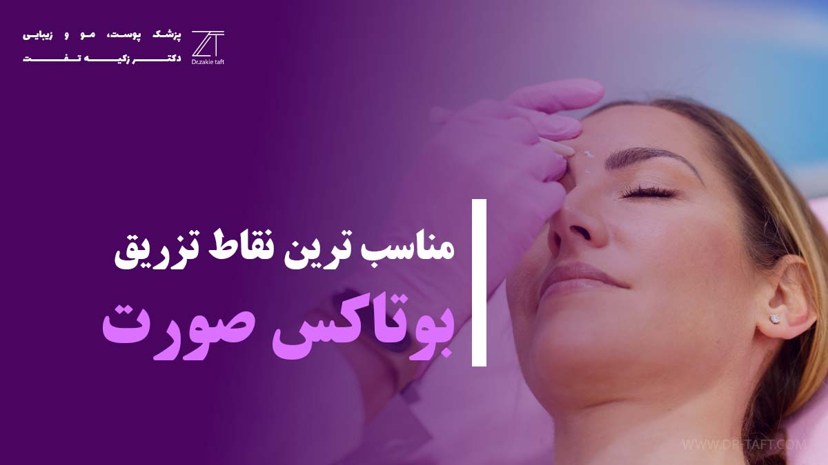 مناسب ترین نقاط تزریق بوتاکس صورت