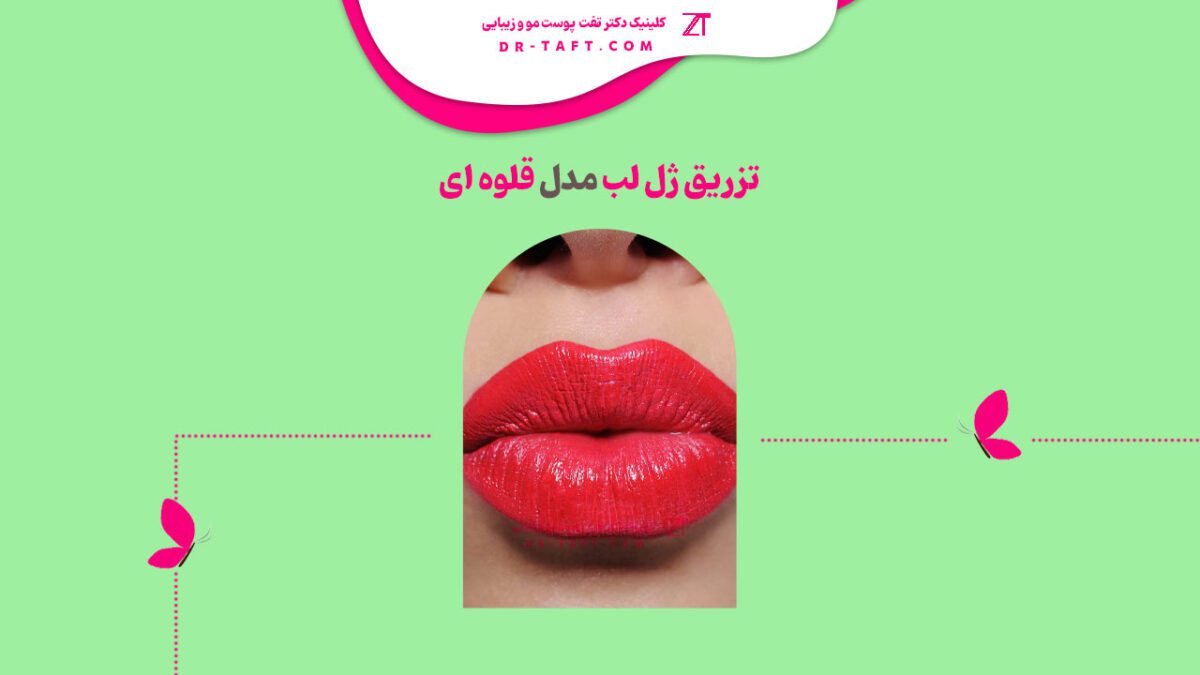 تزریق مدل لب قلوه ای