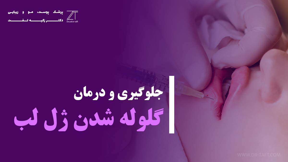 گلوله شدن ژل لب