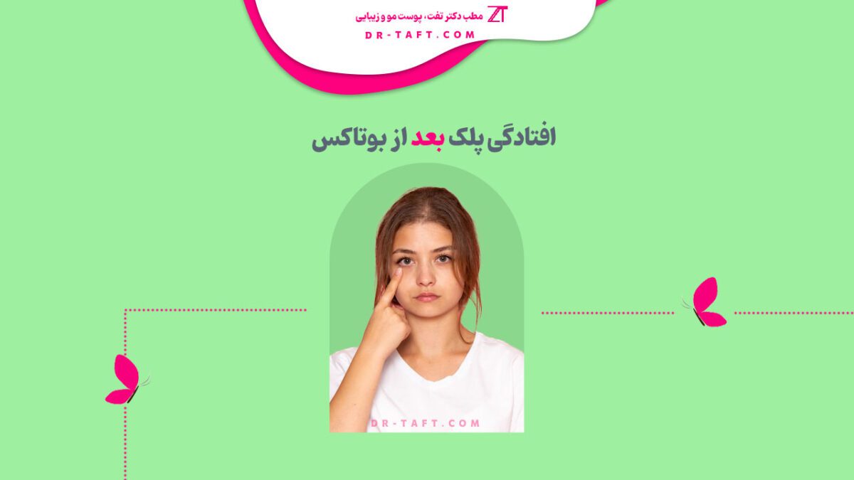 افتادگی پلک بعد از بوتاکس