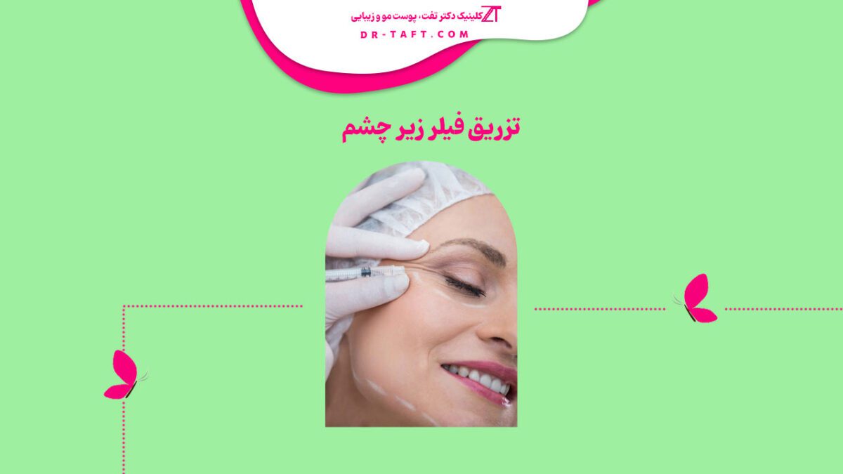 تزریق فیلر زیر چشم
