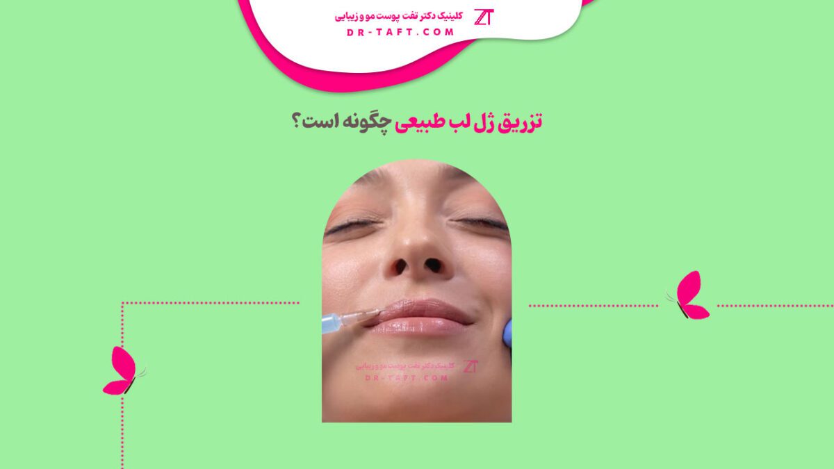 تزریق ژل لب طبیعی