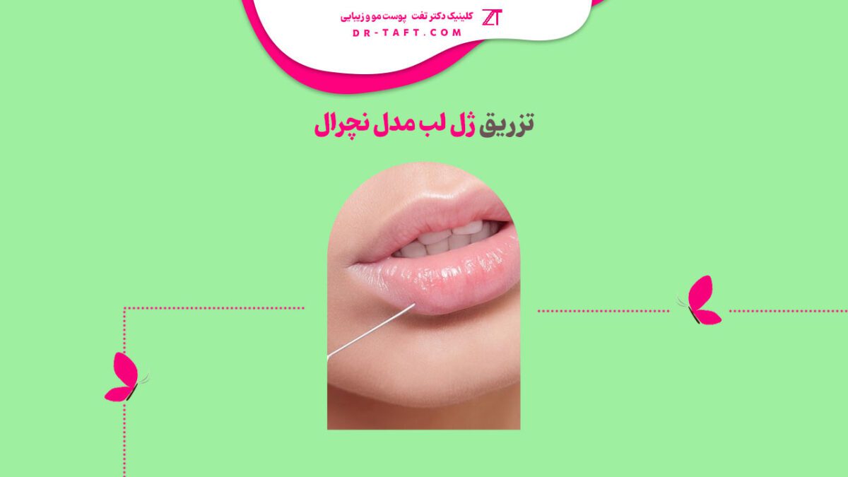 تزریق ژل لب مدل نچرال