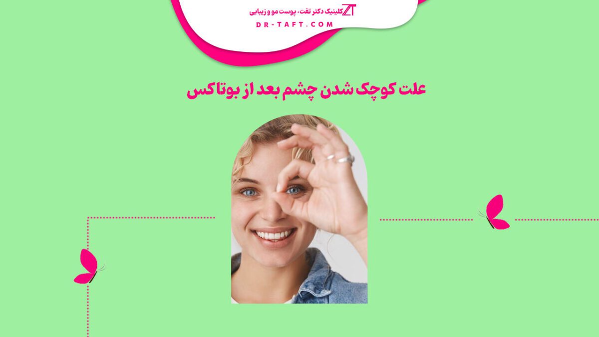 علت کوچک شدن چشم بعد از بوتاکس