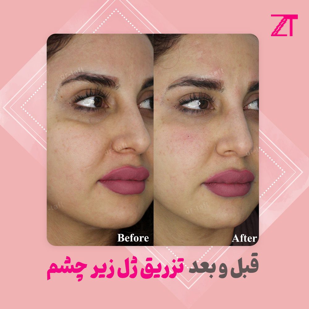 عکس فیلر زیر چشم