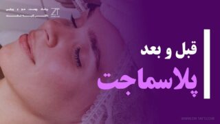 قبل و بعد پلاسما جت پلک