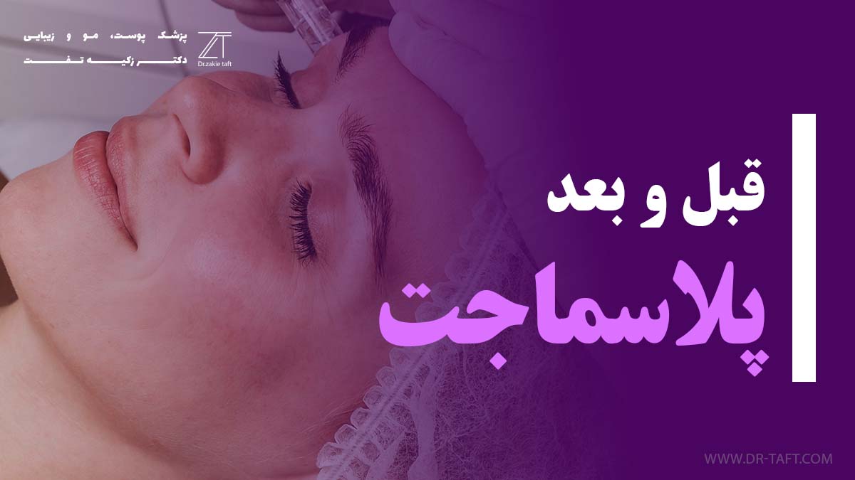 قبل و بعد پلاسما جت پلک