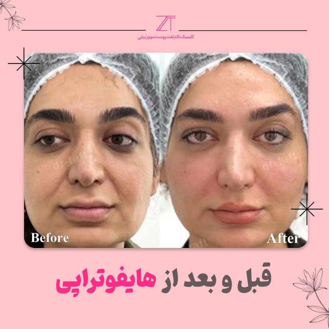 قبل و بعد از هایفوتراپی