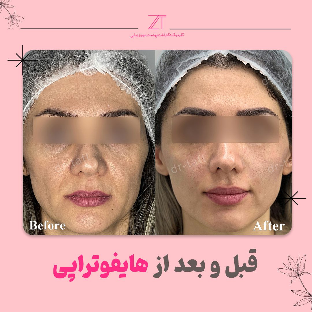 قبل و بعد از هایفوتراپی