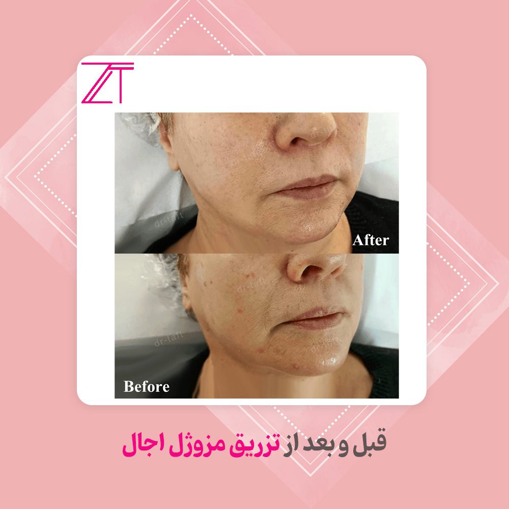 قبل و بعد تزریق مزوژل اجال