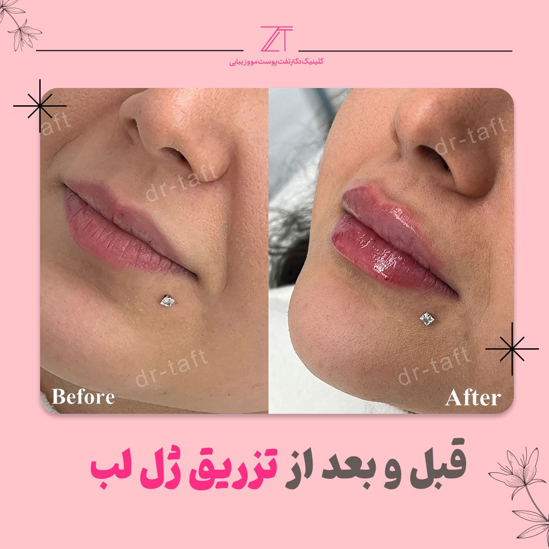 عکس ژل لب یک سی سی