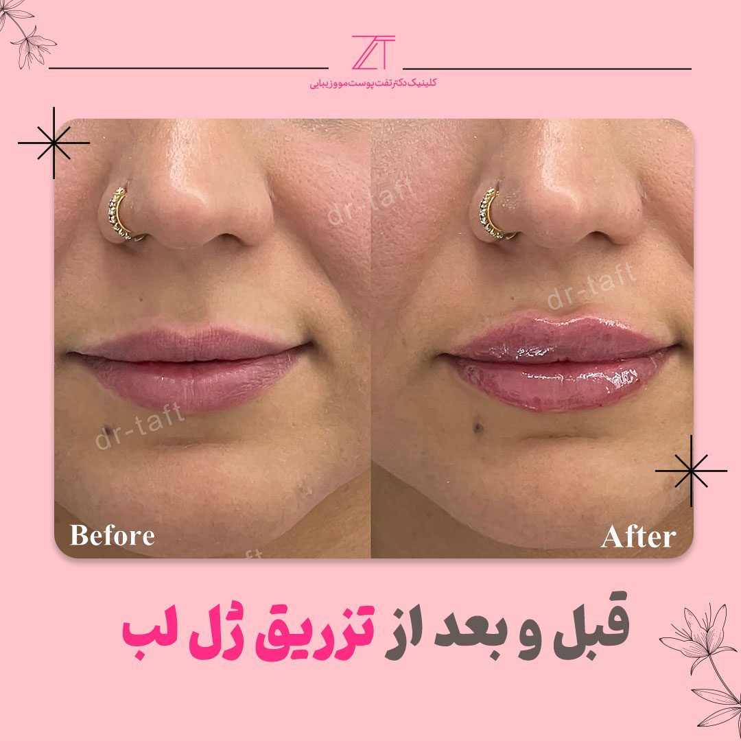 قبل و بعد از تزریق ژل لب
