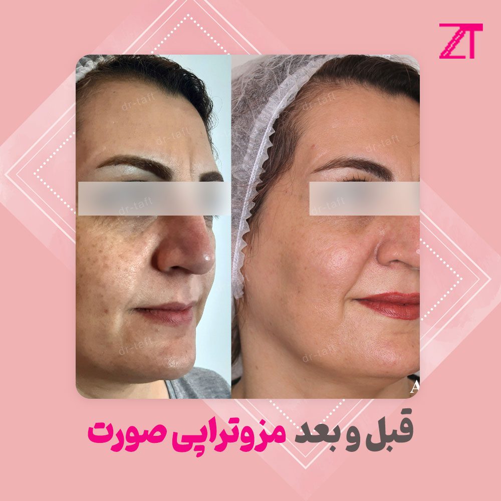 عکس قبل و بعد مزوتراپی صورت