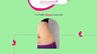 درمان استرچ مارک