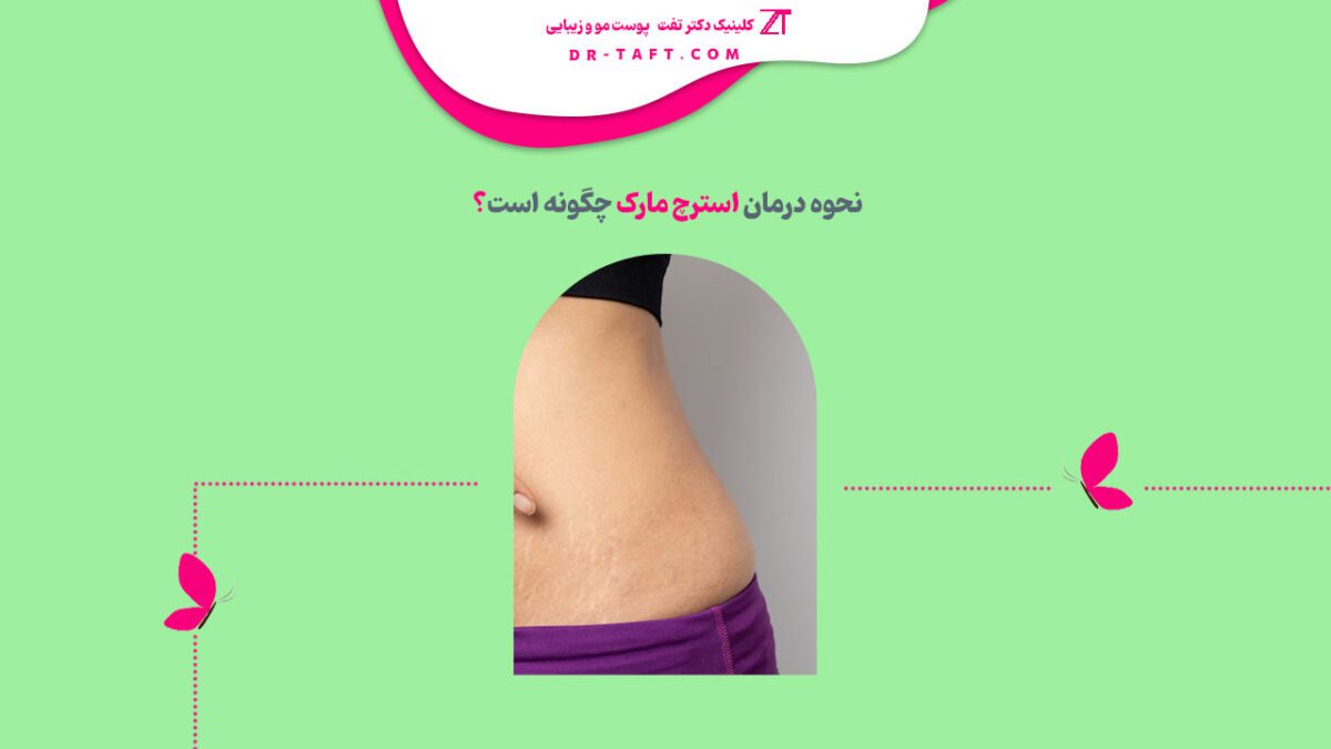درمان استرچ مارک