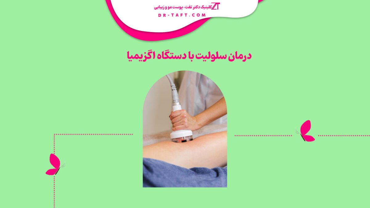 درمان سلولیت با دستگاه اگزیمیا