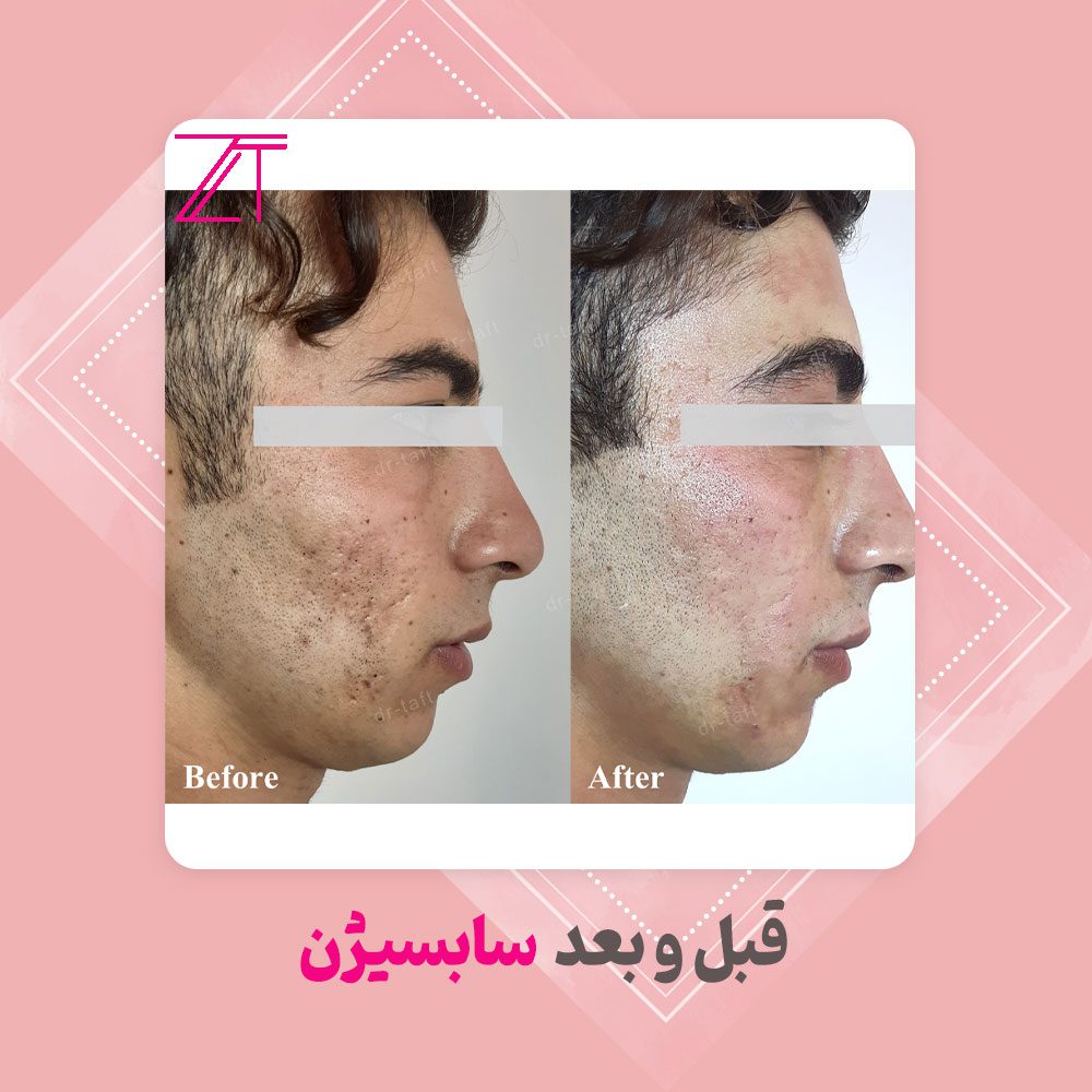 عکس قبل و بعد سابسیژن