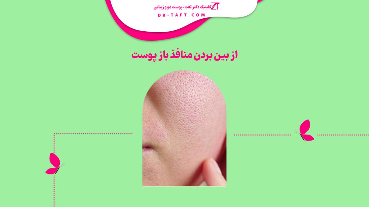 از بین بردن منافذ باز پوست