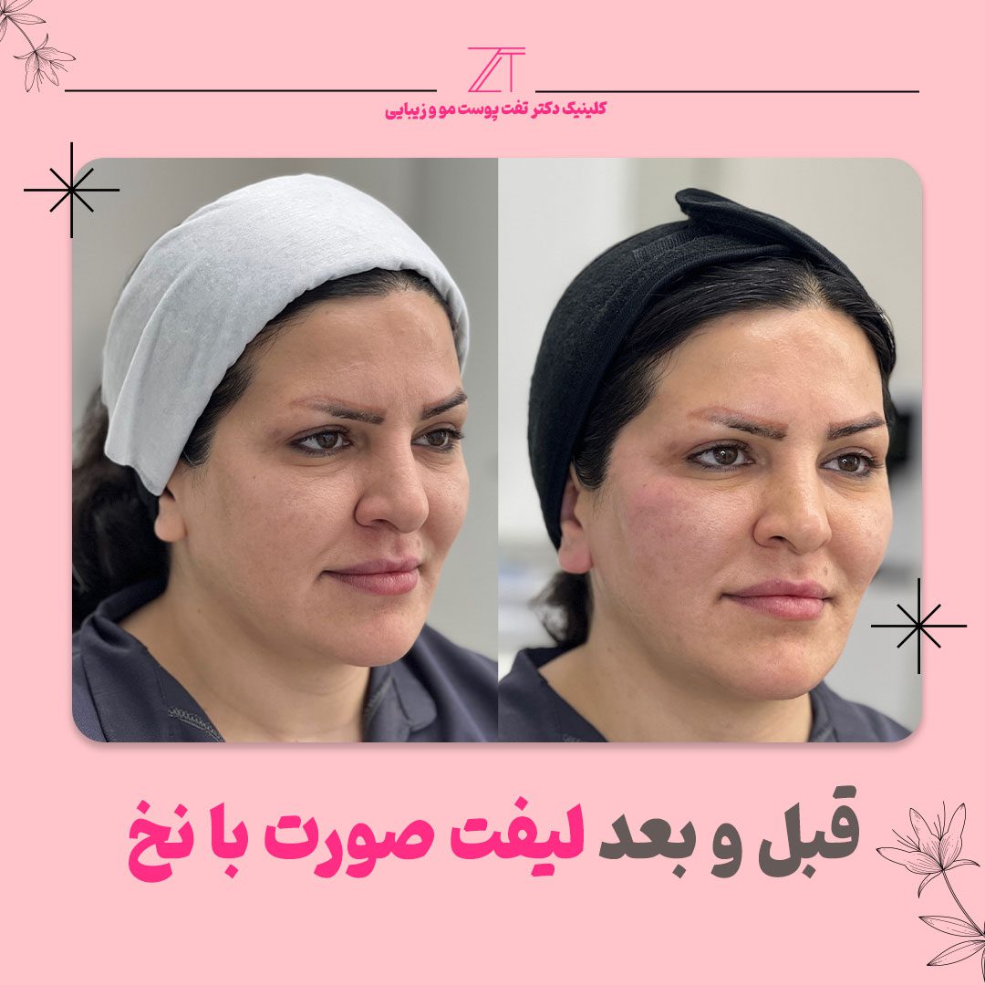عکس قبل و بعد لیفت صورت با نخ
