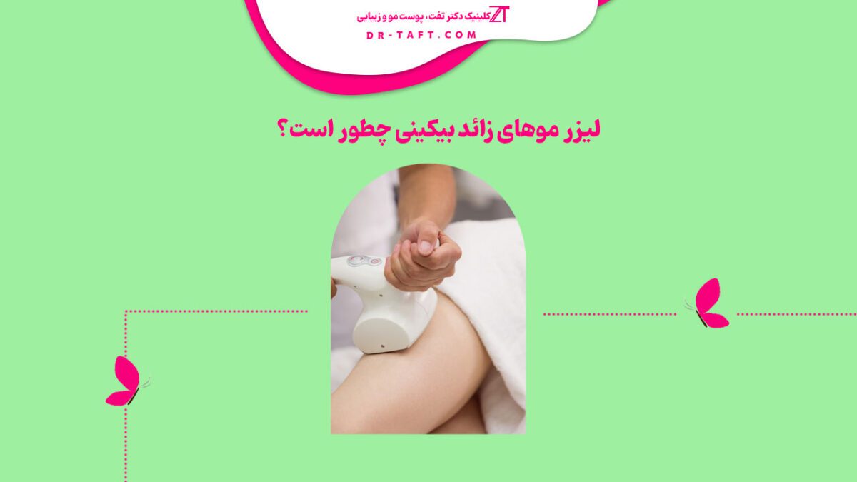 لیزر موهای زائد بیکینی