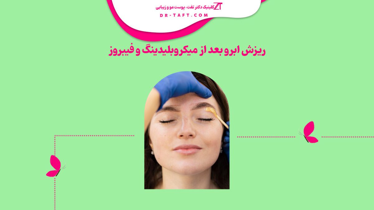 ریزش ابرو بعد از میکروبلیدینگ و فیبروز