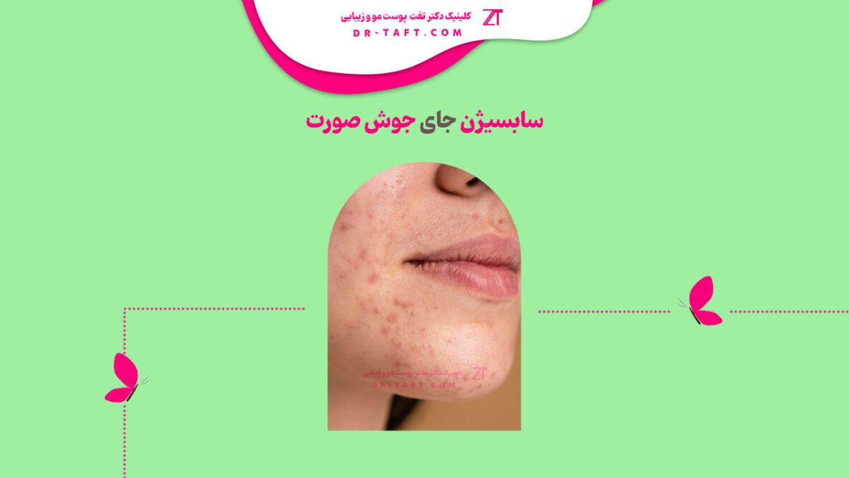 سابسیژن جای جوش صورت چیست