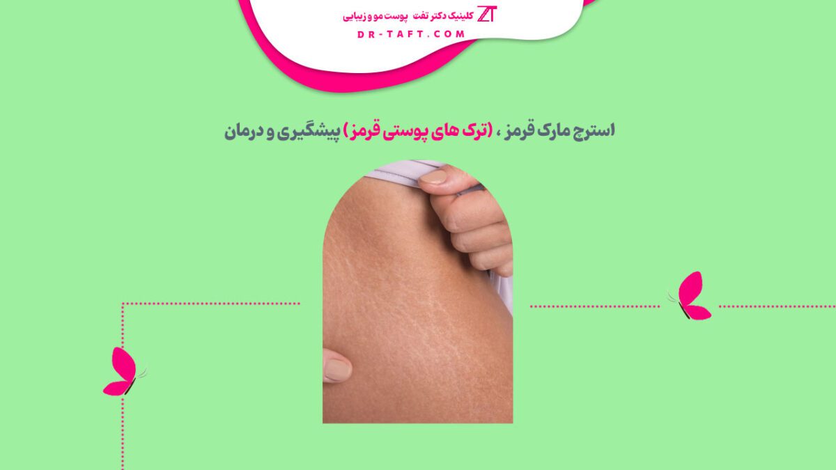 استرچ مارک قرمز، (ترک های پوستی قرمز)