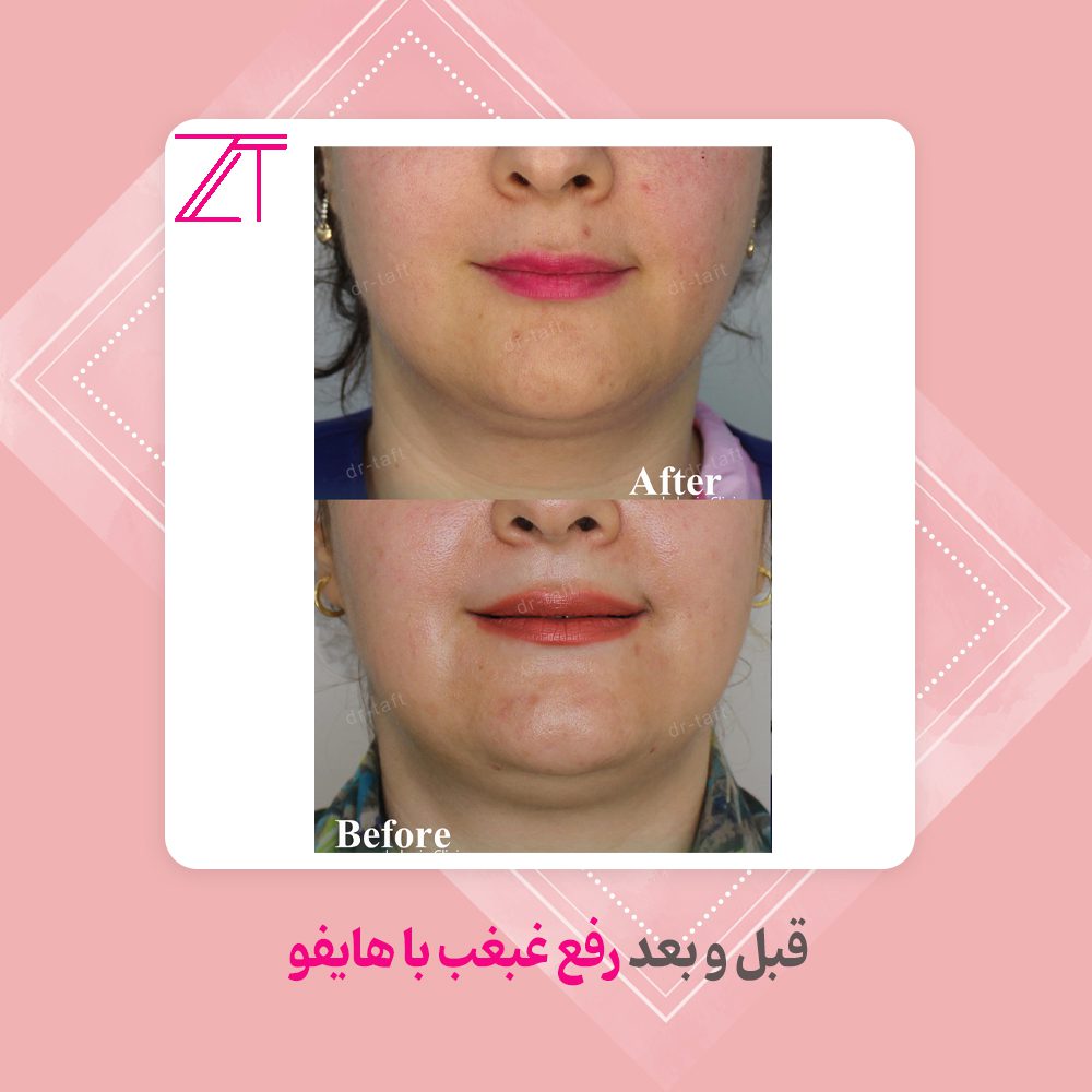 سریع‌ترین راه رفع غبغب با هایفوتراپی