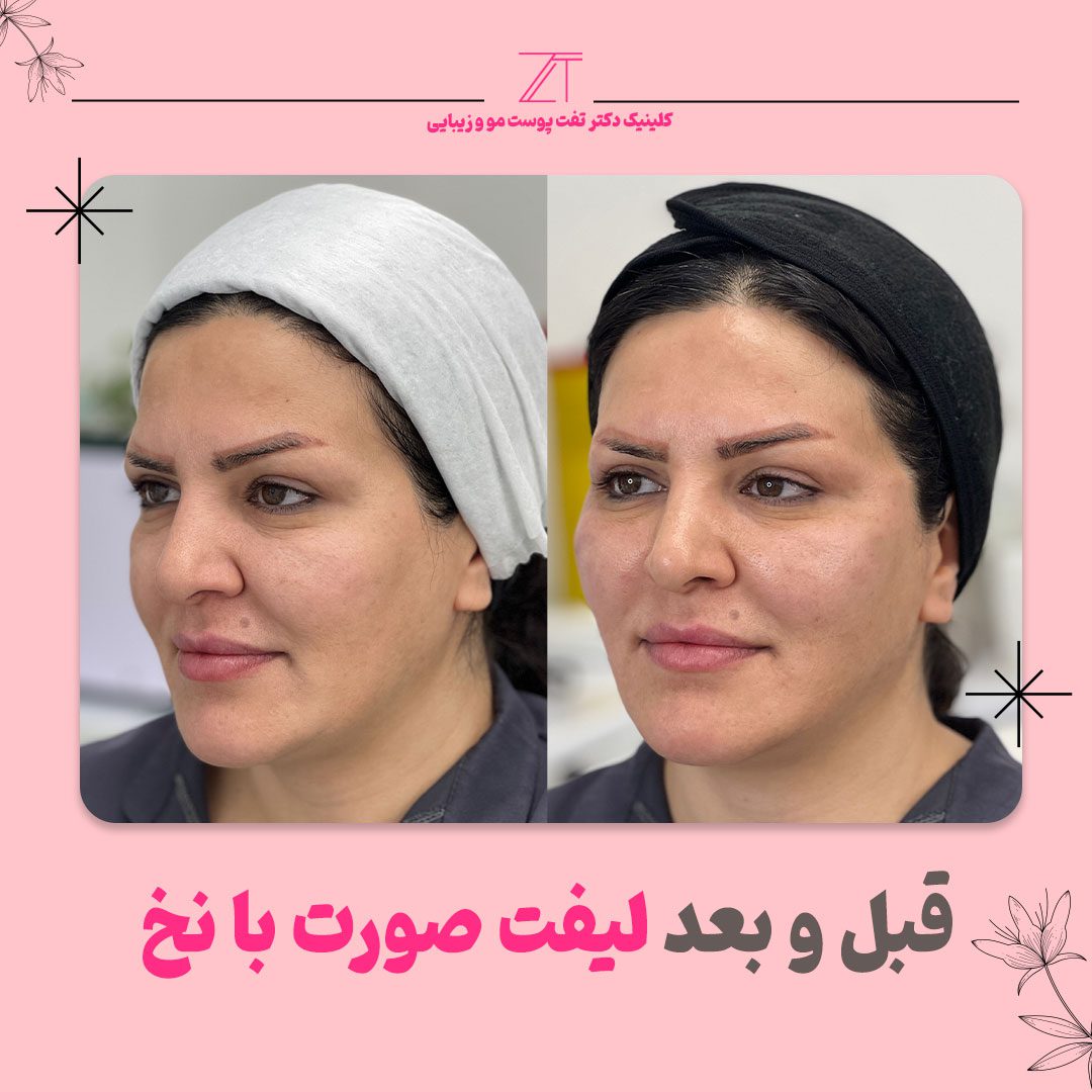 لیفت چشم گربه‌ای با نخ