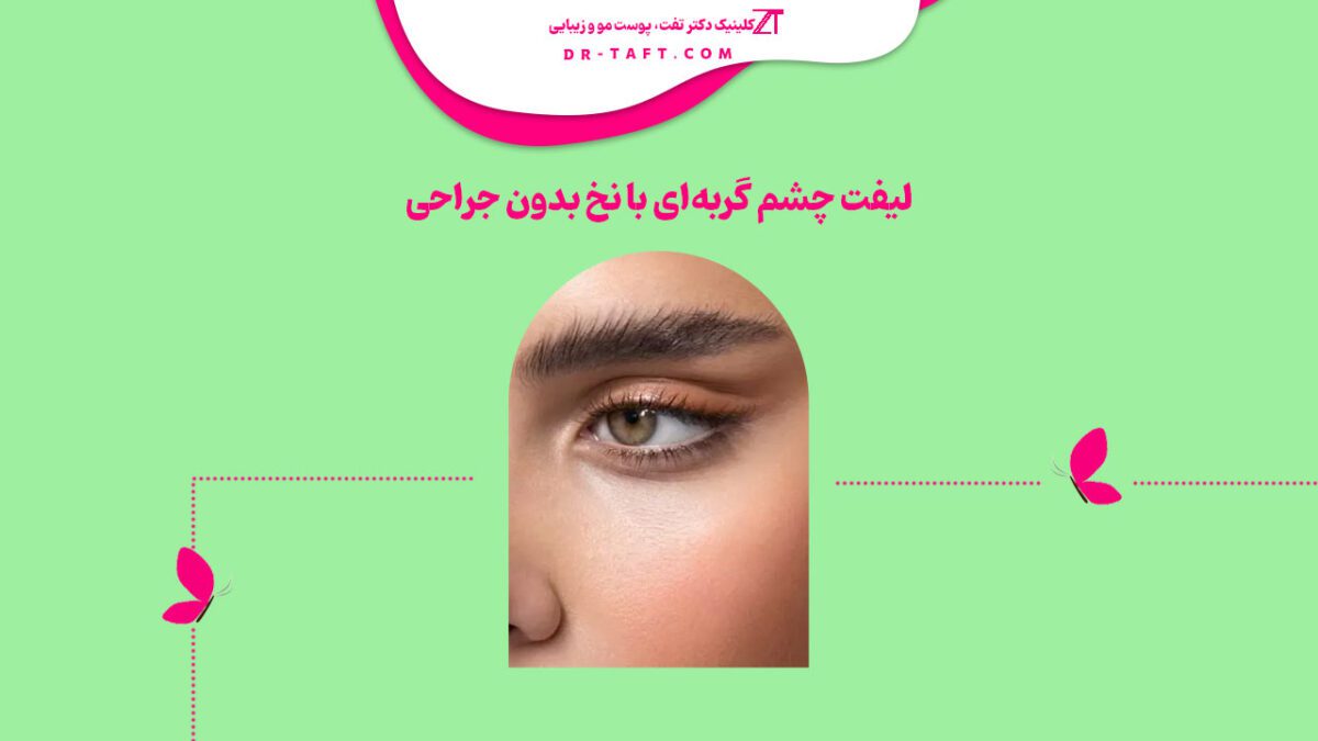 لیفت چشم گربه‌ای با نخ (بدون جراحی)