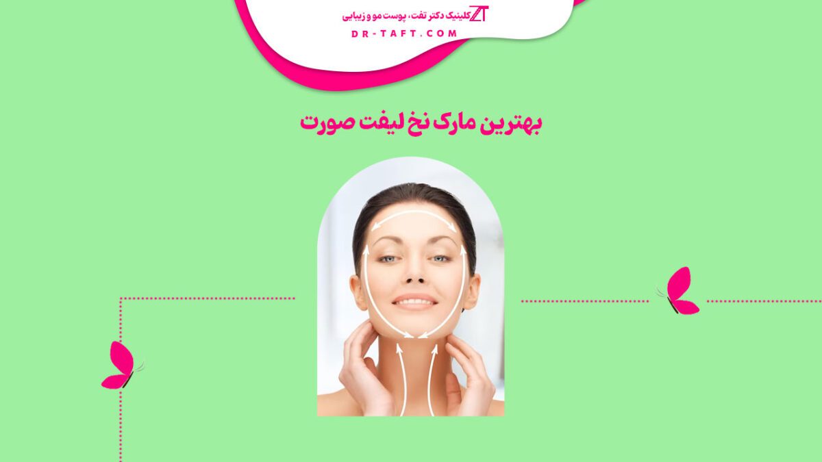 بهترین مارک نخ لیفت صورت