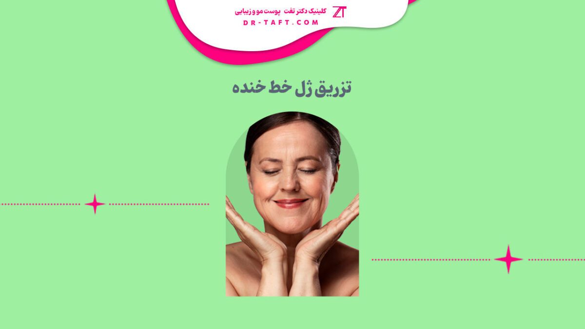 تزریق ژل خط خنده