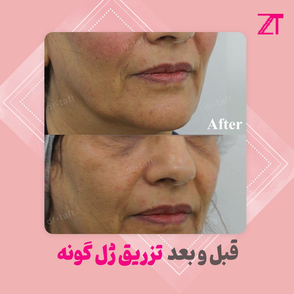 عکس قبل و بعد ژل گونه