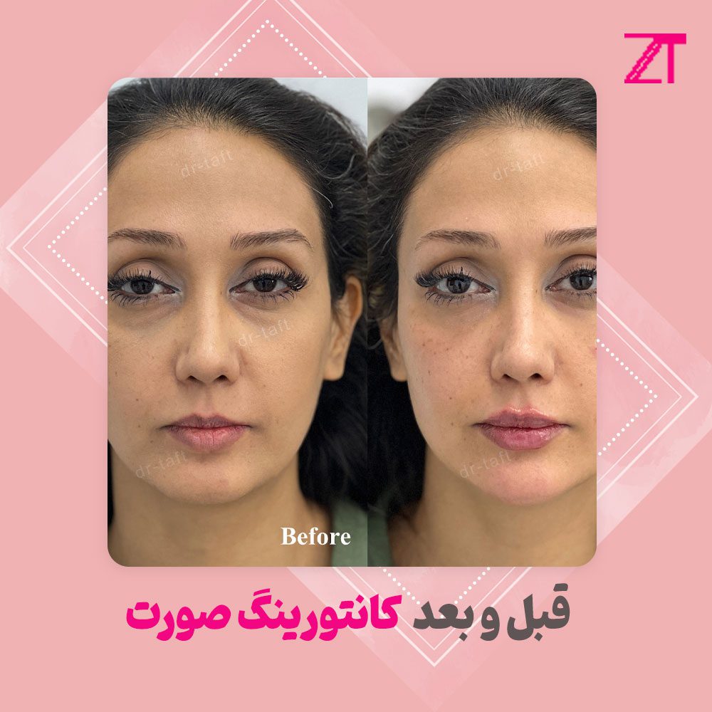 عکس قبل و بعد کانتورینگ صورت
