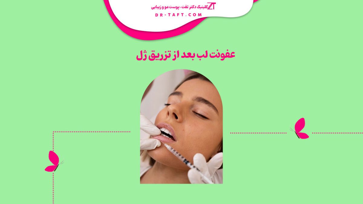 عفونت لب بعد از تزریق ژل