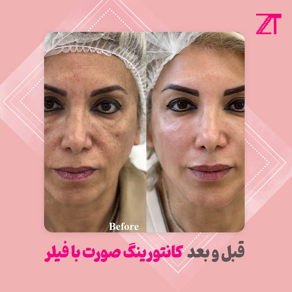 عکس قبل و بعد کانتورینگ صورت با ژل