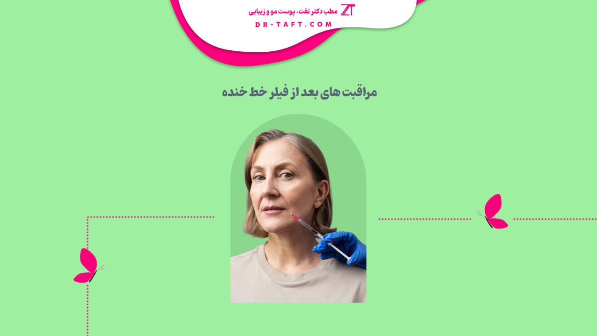 مراقبت بعد از فیلر خط خنده