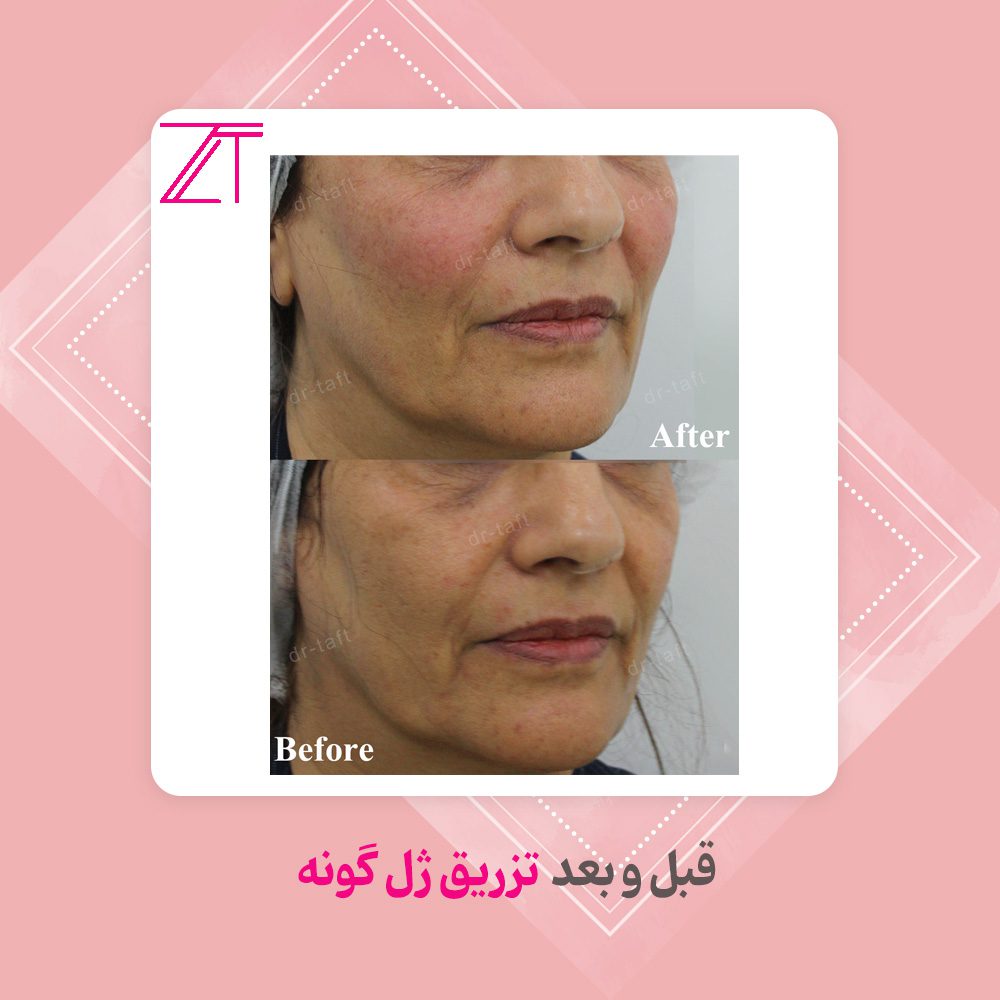 بهترین دکتر فیلر گونه در تهران