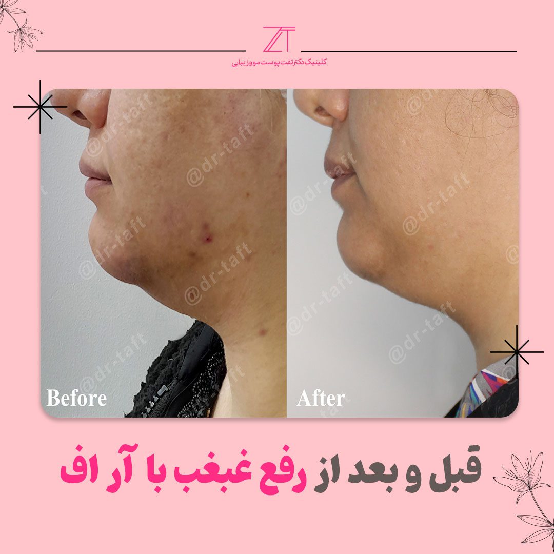 رفع غبغب با آر اف