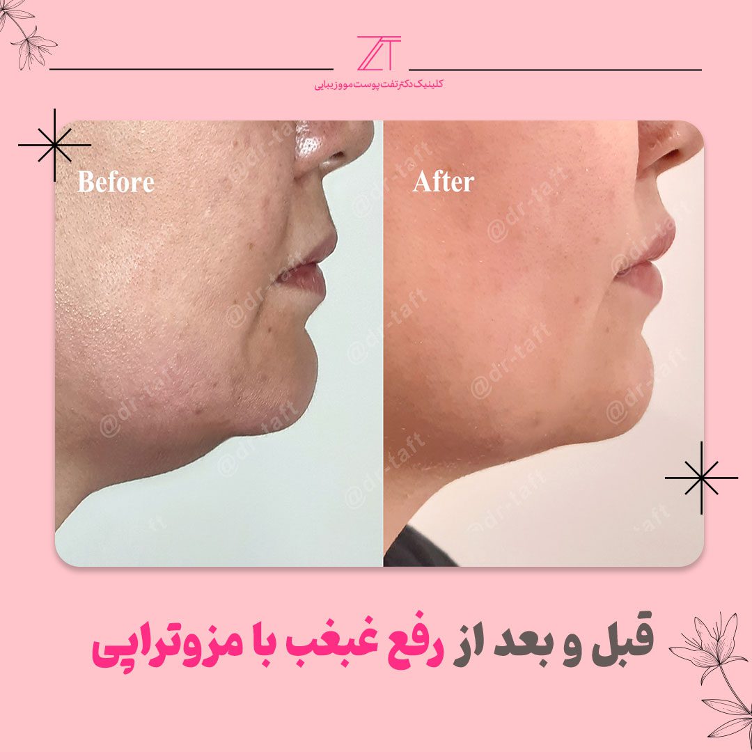 رفع غبغب با مزوتراپی