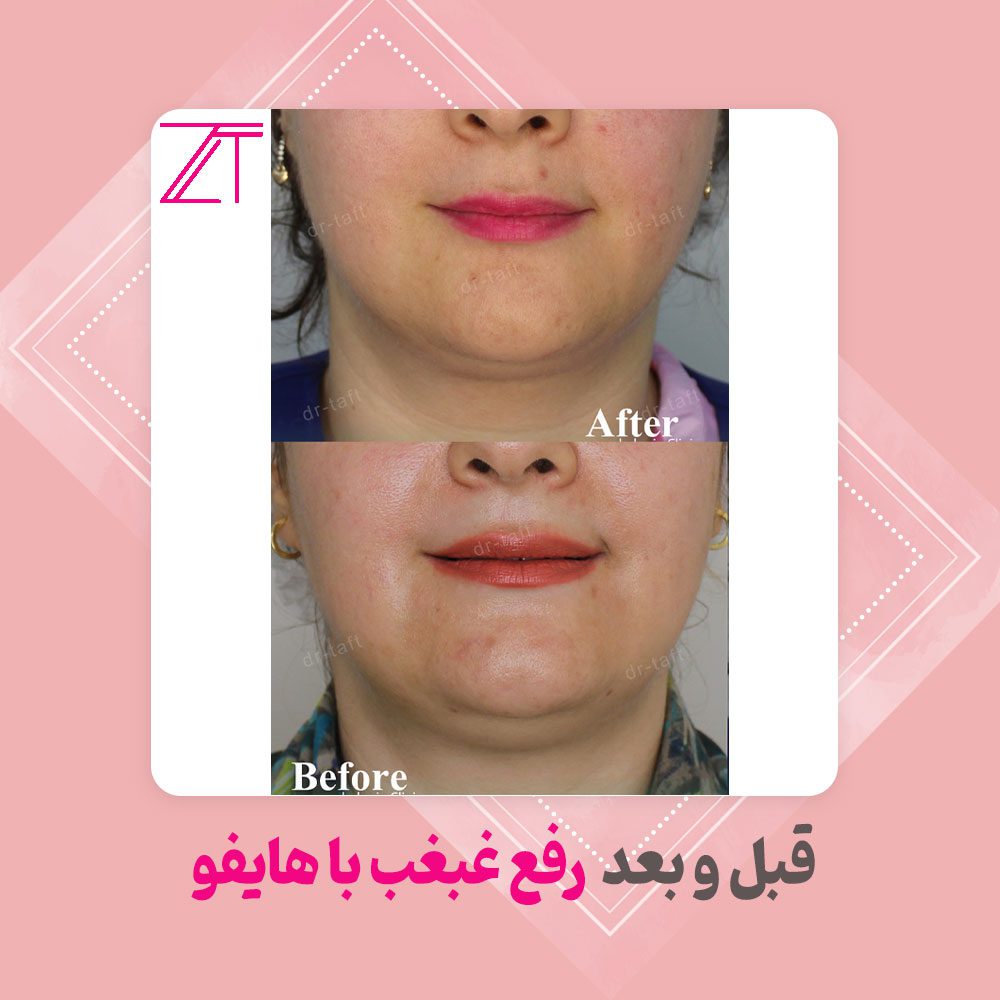 رفع غبغب با هایفو