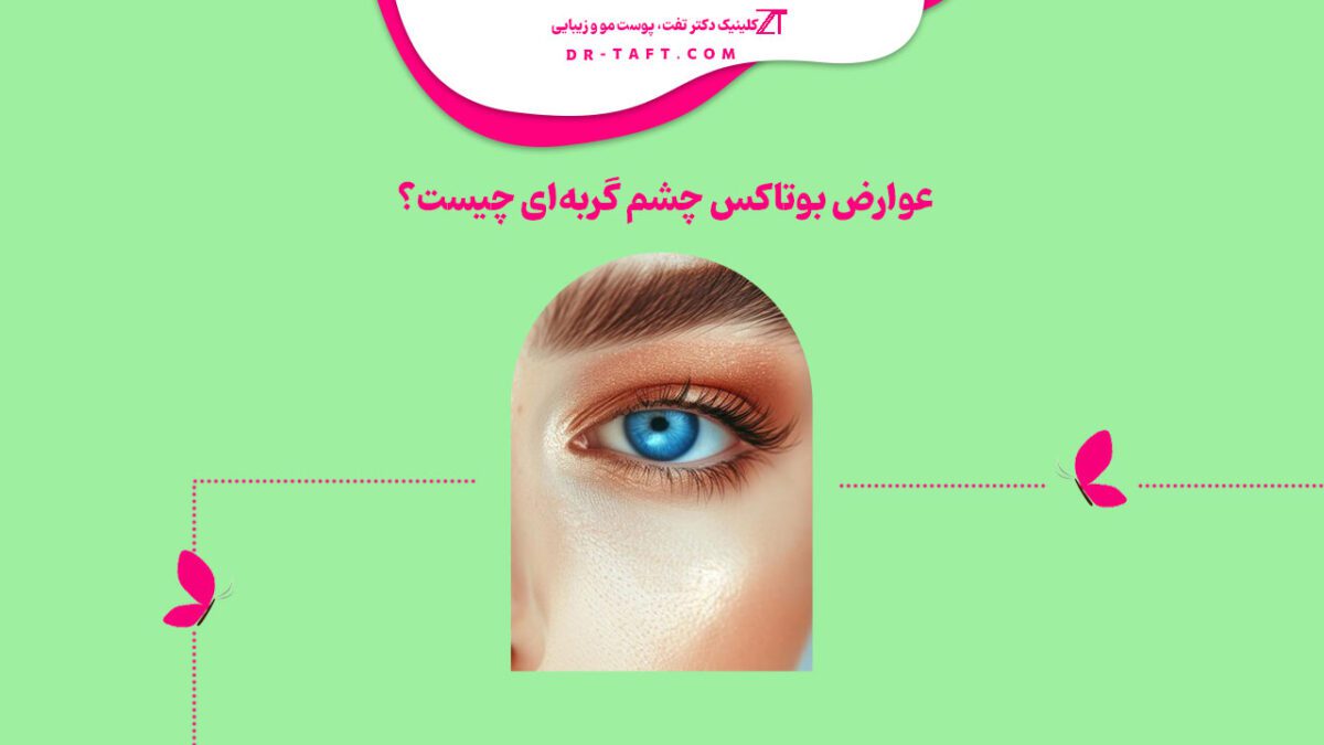 عوارض بوتاکس چشم گربه‌ای چیست