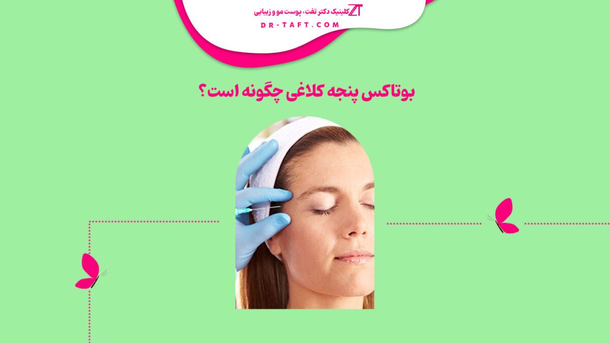 بوتاکس پنجه کلاغی چگونه است