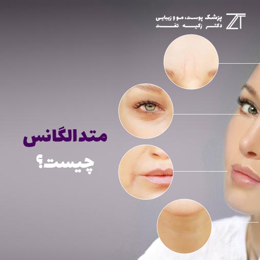 متدالگانس چیست؟