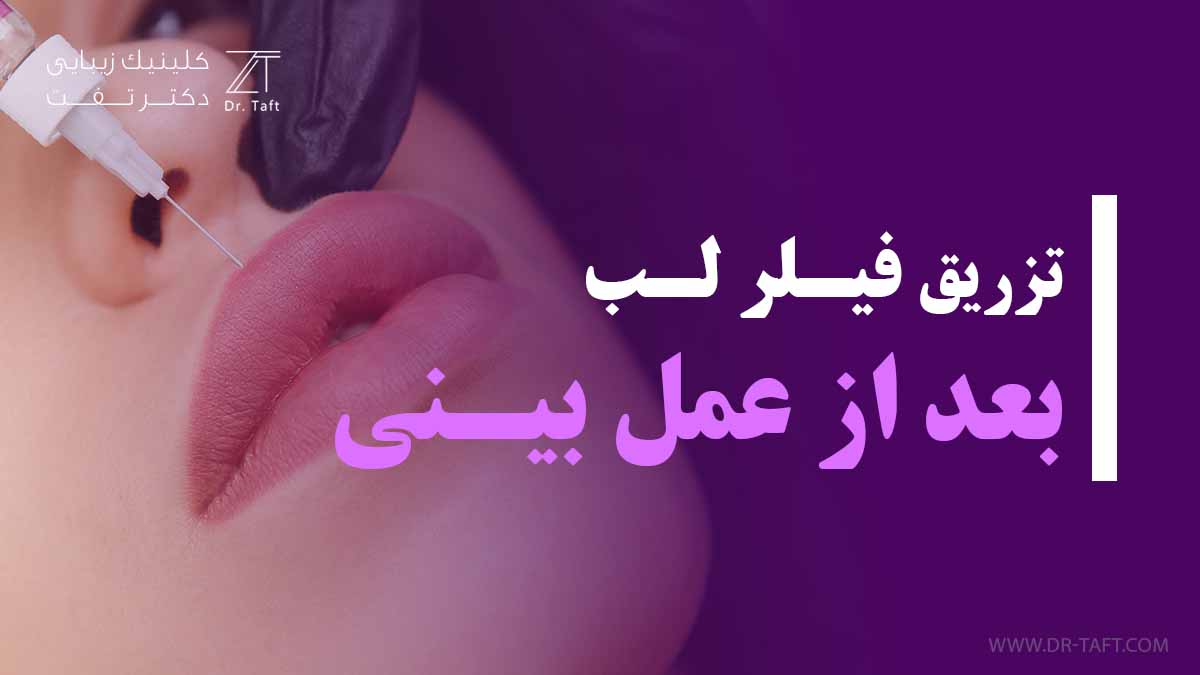 تزریق ژل لب بعد عمل بینی