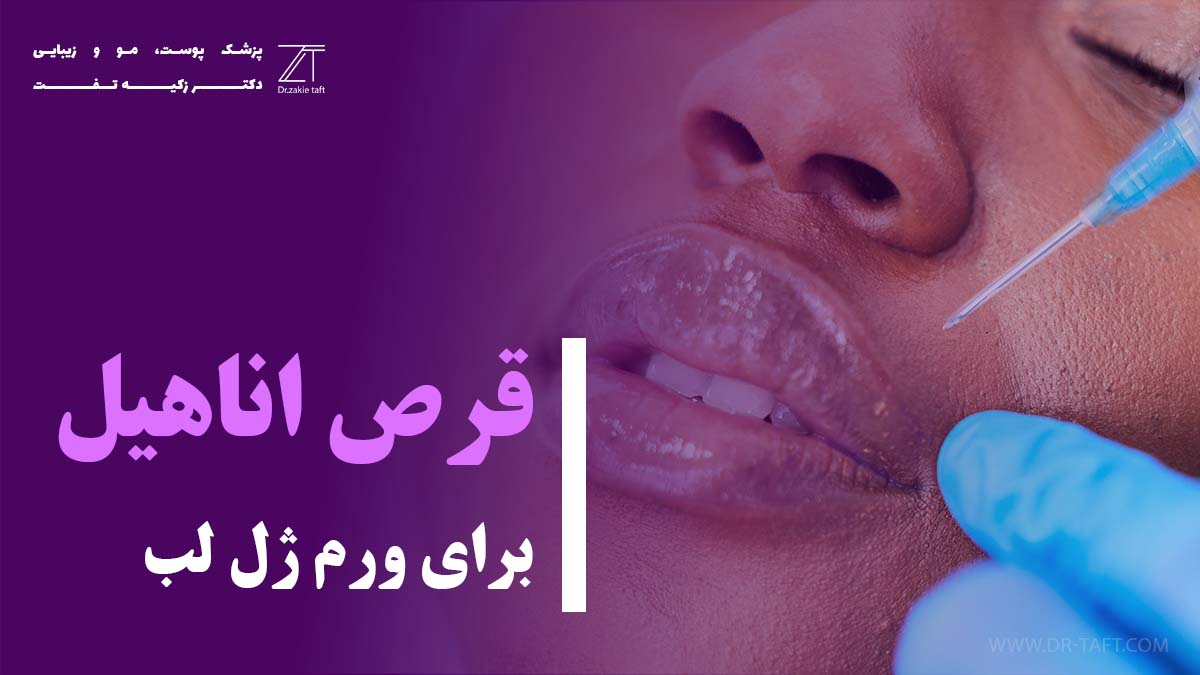 قرص اناهیل برای ورم ژل لب