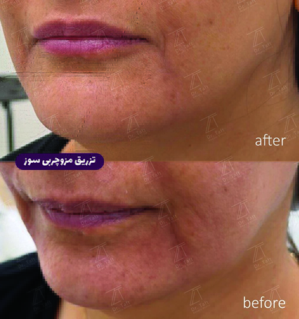 چربی سوز صورت