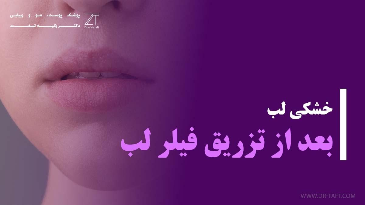 خشکی لب بعد از تزریق ژل لب